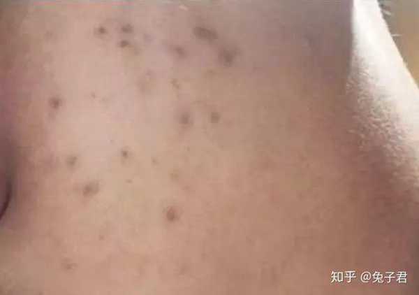 男脸上的痘印怎么去除(脸上的痘印能治好吗)照片 - 3 图片 - 3