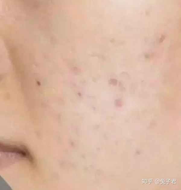 男脸上的痘印怎么去除(脸上的痘印能治好吗)照片 - 4 图片 - 4