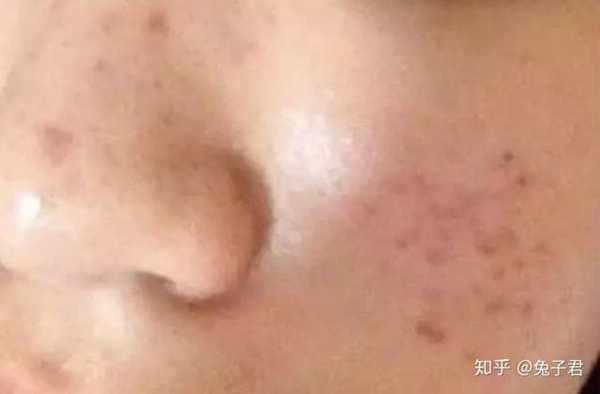 男脸上的痘印怎么去除(脸上的痘印能治好吗)照片 - 2 图片 - 2